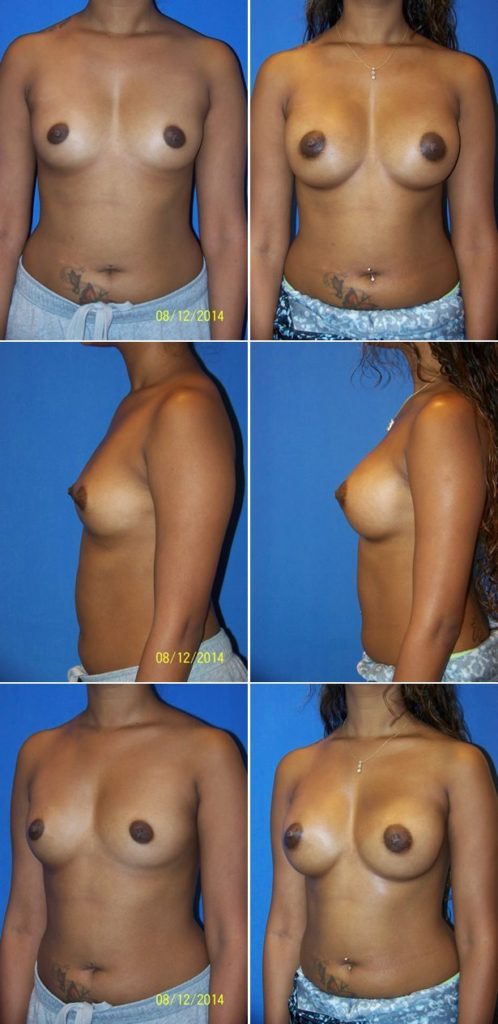 Before and After Image: Breast Augmentation - other