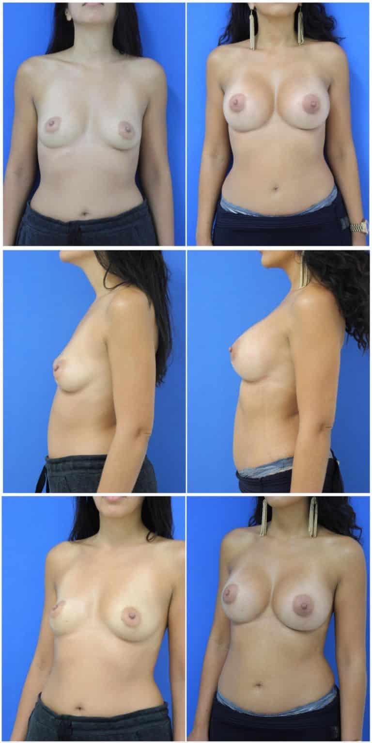 Before and After Image: Breast Augmentation - other