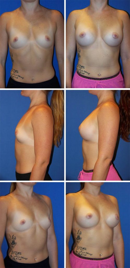 Before and After Image: Breast Augmentation - other