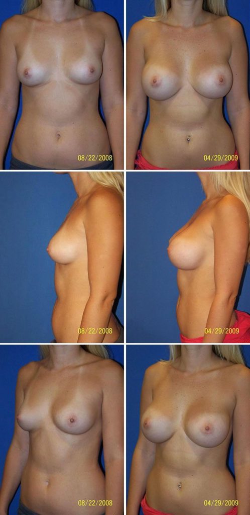 Before and After Image: Breast Augmentation - other