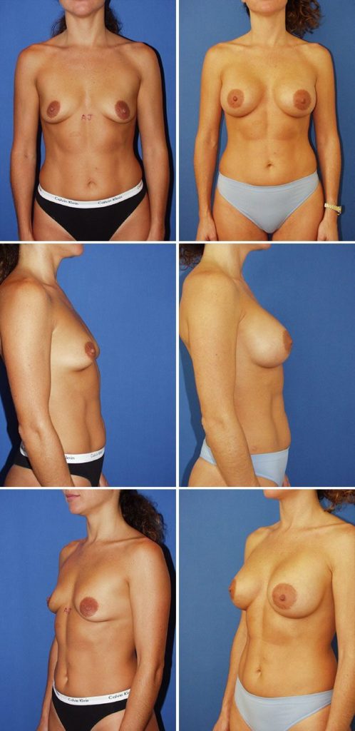 Before and After Image: Breast Augmentation - other