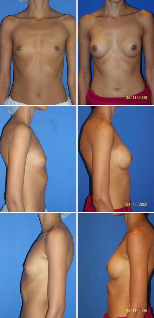 Before and After Image: Breast Augmentation - other