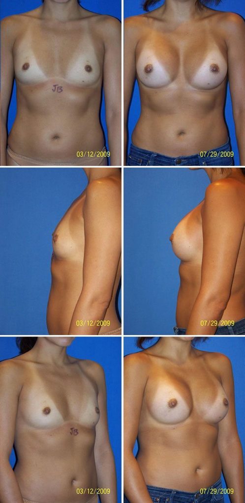 Before and After Image: Breast Augmentation - other