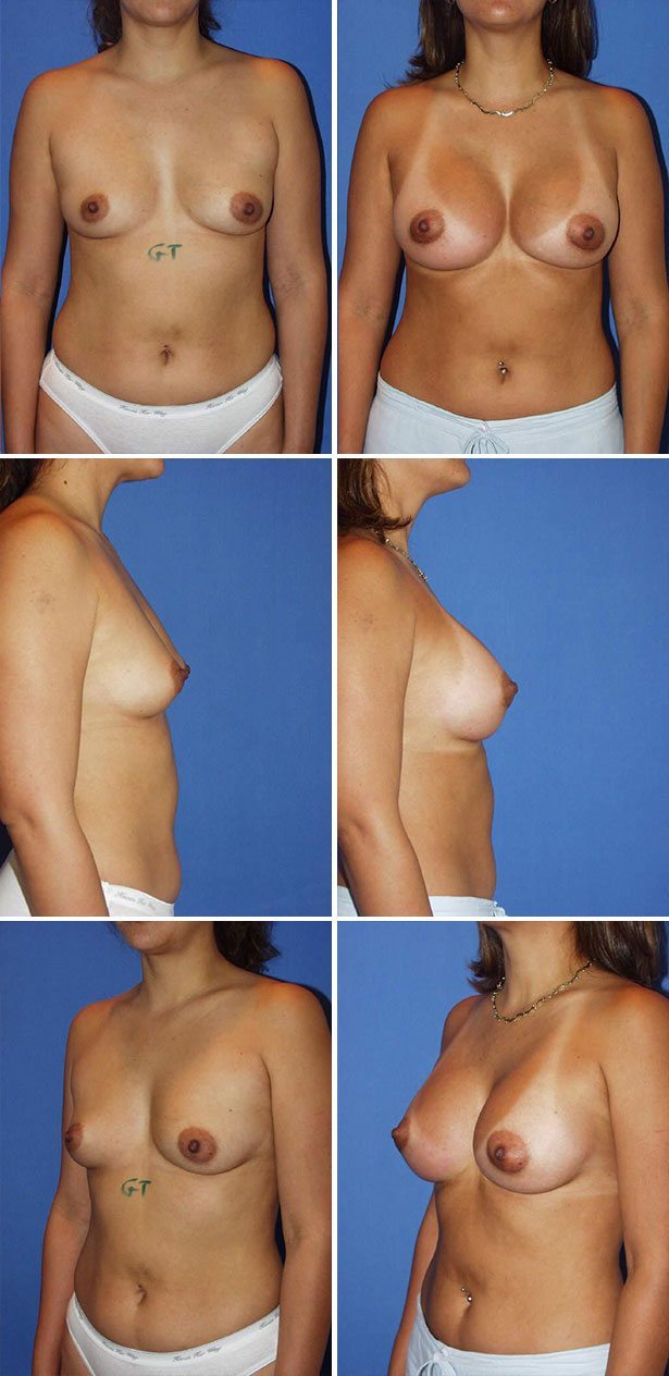 Before and After Image: Breast Augmentation - other