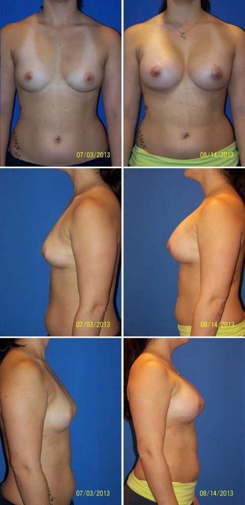 Before and After Image: Breast Augmentation - other