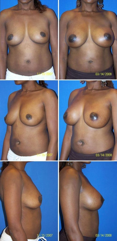 Before and After Image: Breast Augmentation - other