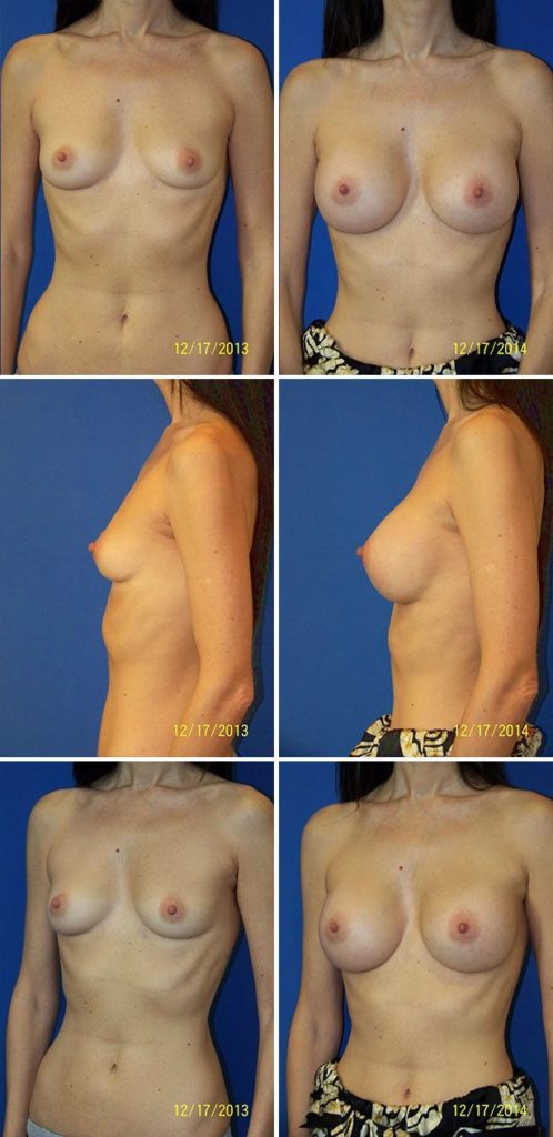Before and After Image: Breast Augmentation - other