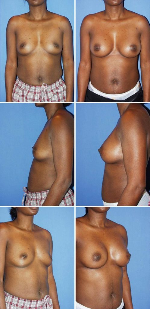 Before and After Image: Breast Augmentation - other