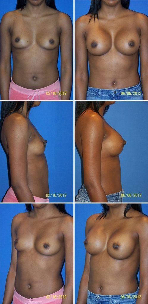 Before and After Image: Breast Augmentation - front