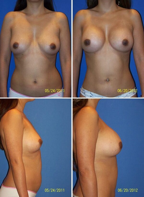 Before and After Image: Breast Augmentation - other