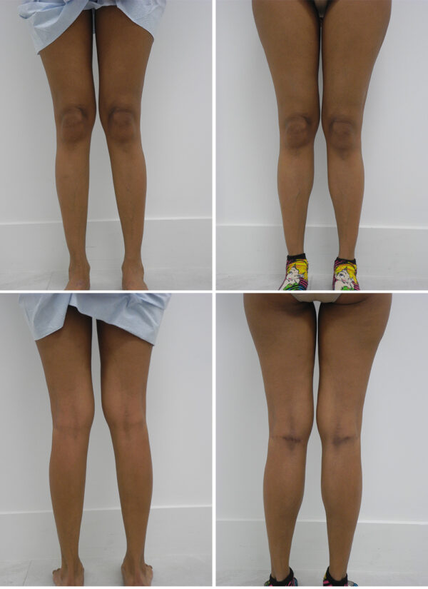 Before and After Image: Calf Augmentation - other