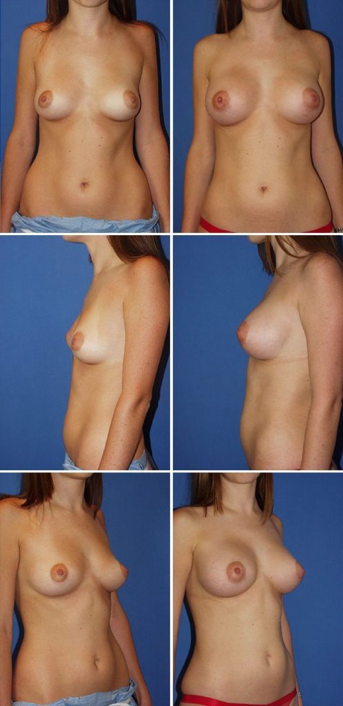 Before and After Image: Breast Augmentation - other