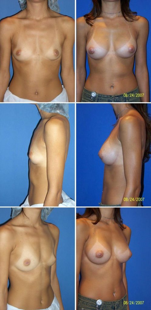 Before and After Image: Breast Augmentation - other