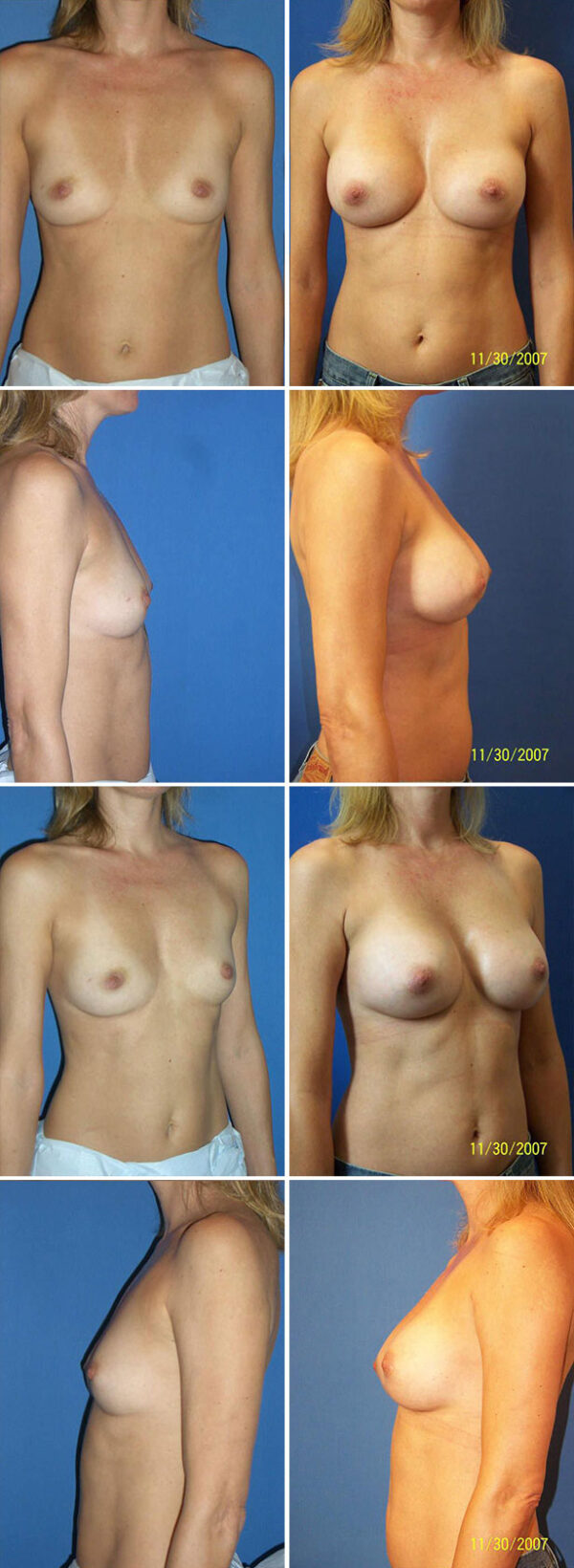 Before and After Image: Breast Augmentation - other