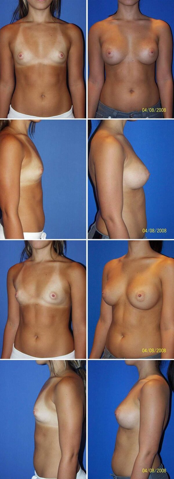 Before and After Image: Breast Augmentation - other