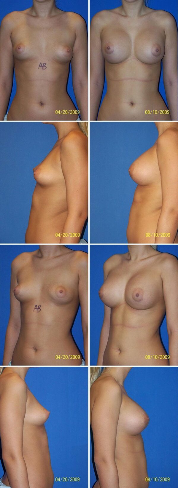 Before and After Image: Breast Augmentation - other
