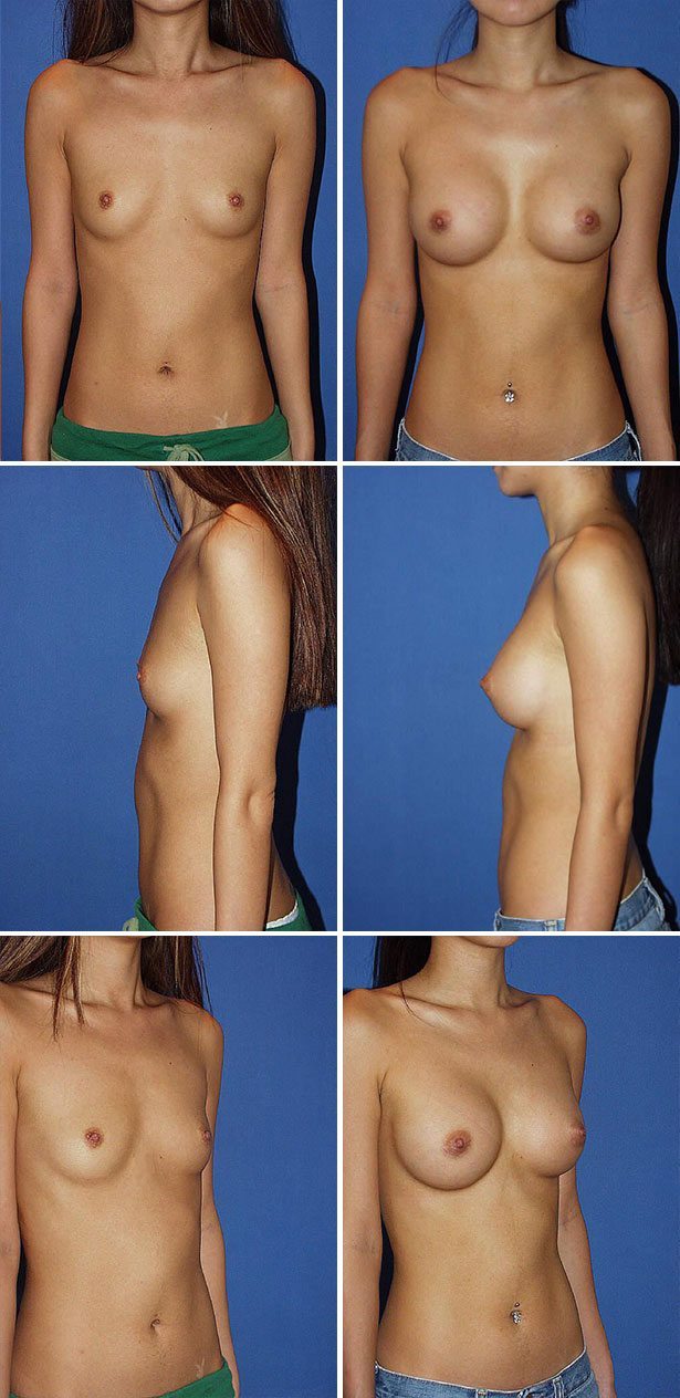Before and After Image: Breast Augmentation - other