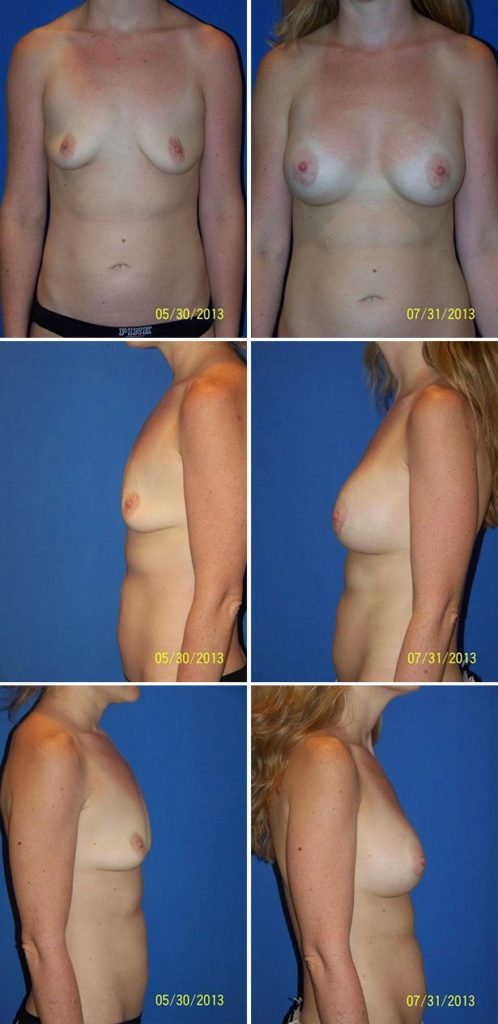 Before and After Image: Breast Augmentation - other