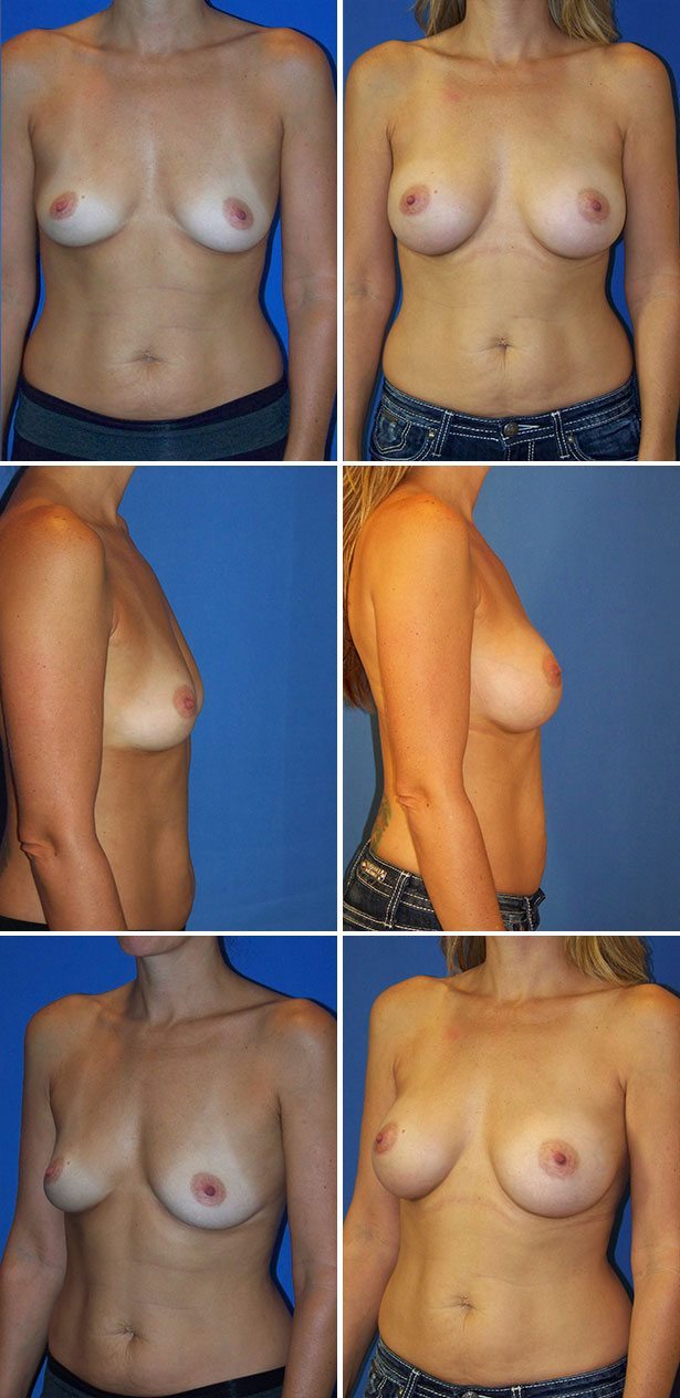 Before and After Image: Breast Augmentation - other