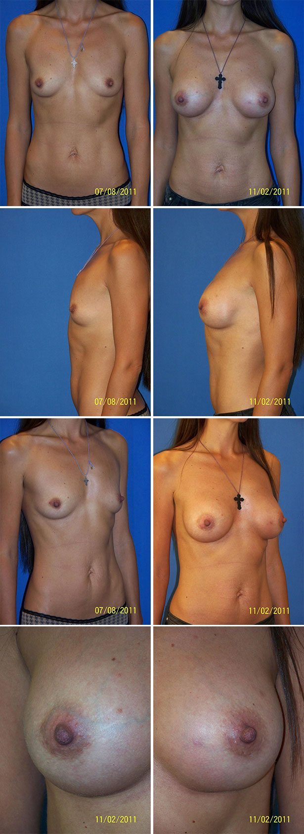Before and After Image: Breast Augmentation - other