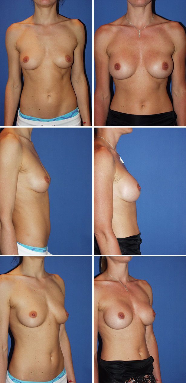 Before and After Image: Breast Augmentation - other