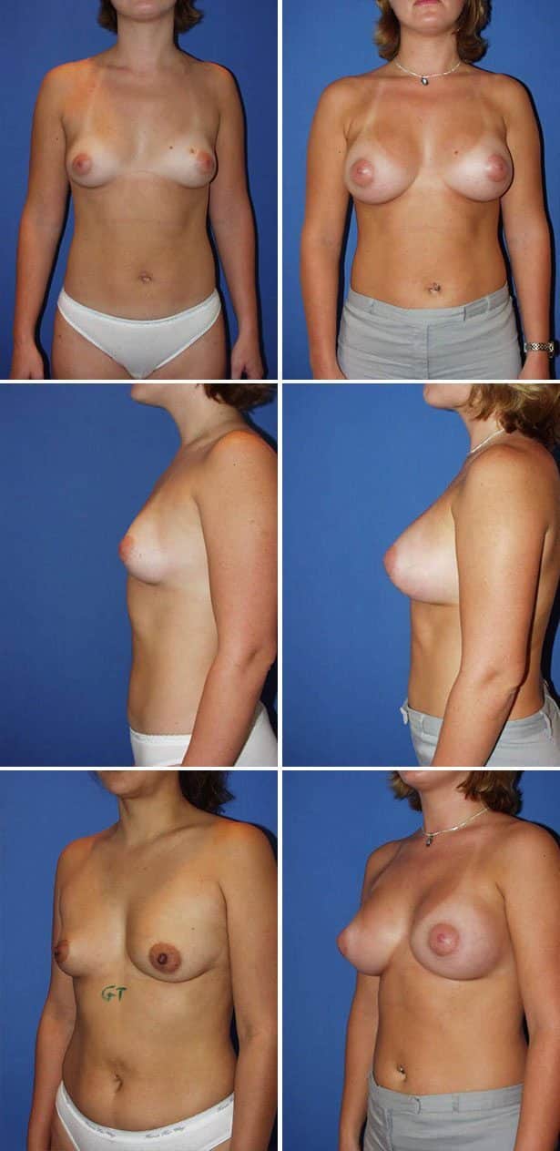 Before and After Image: Breast Augmentation - other