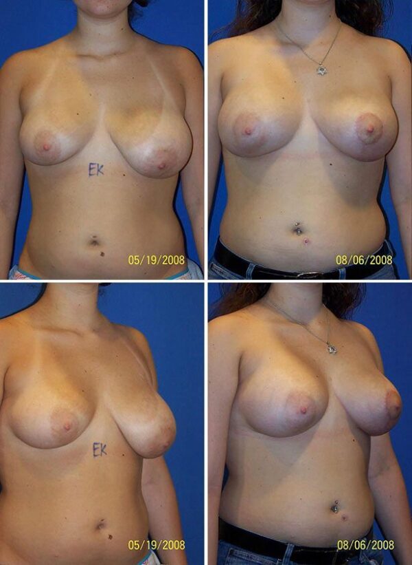 Before and After Image: Breast Augmentation - other