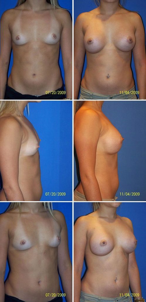 Before and After Image: Breast Augmentation - other