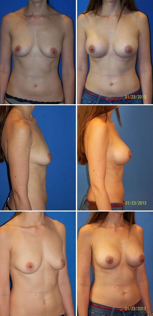 Before and After Image: Breast Augmentation - other