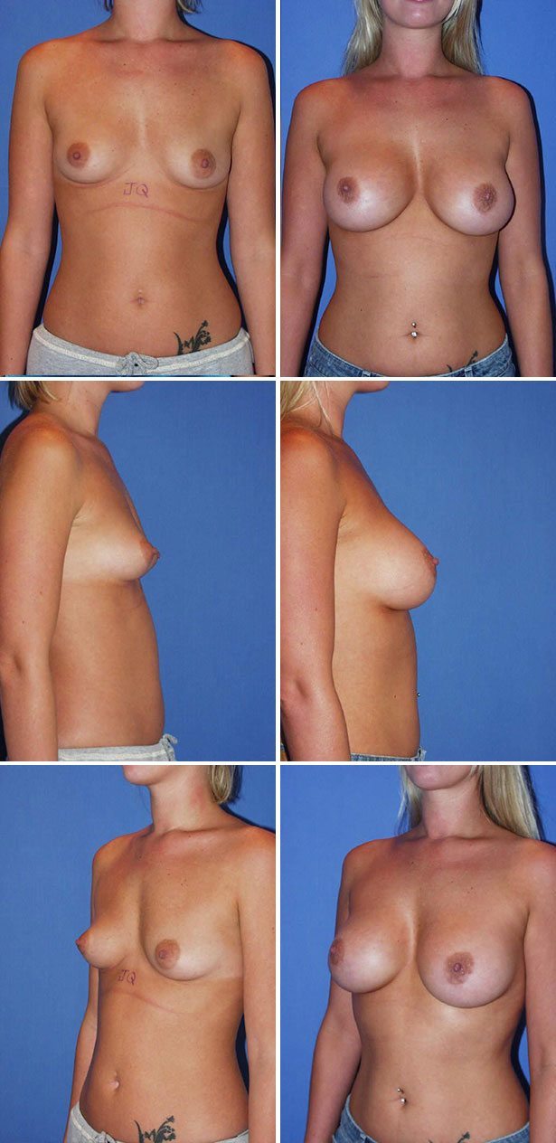 Before and After Image: Breast Augmentation - other