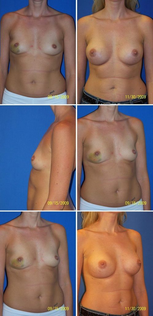 Before and After Image: Breast Augmentation - other