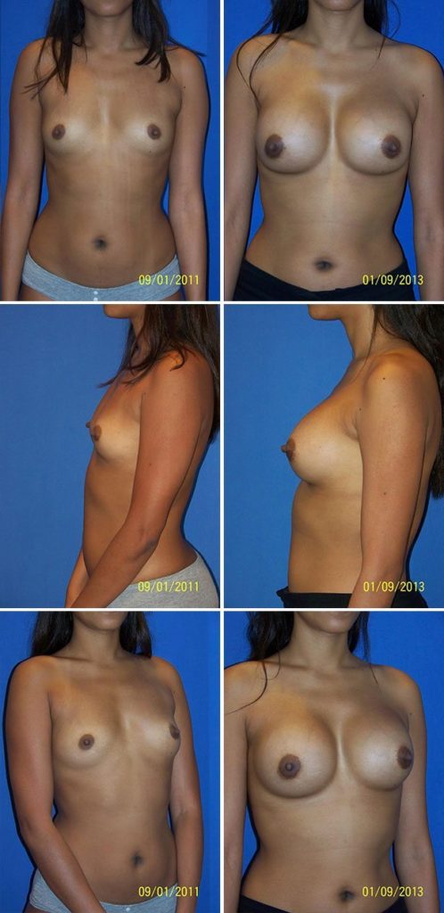 Before and After Image: Breast Augmentation - other