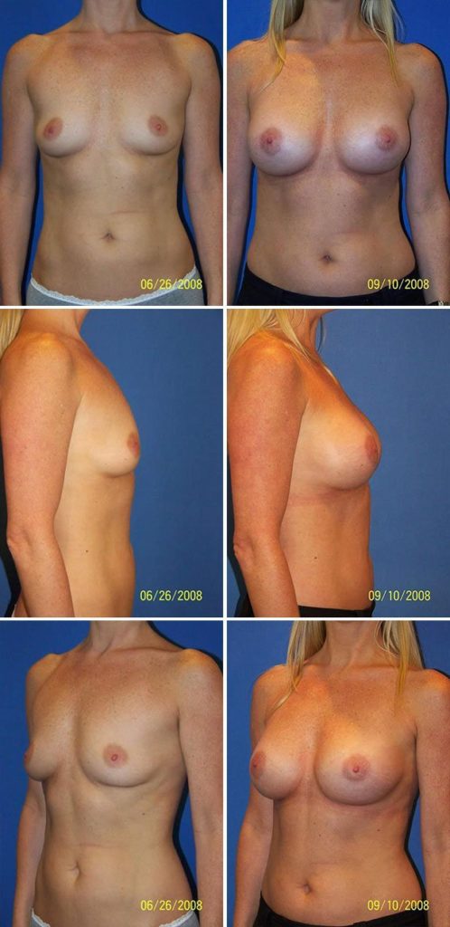 Before and After Image: Breast Augmentation - other