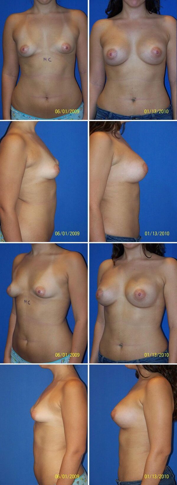 Before and After Image: Breast Augmentation - other