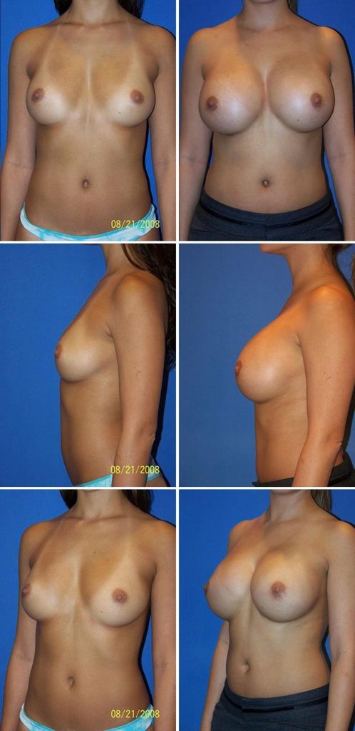 Before and After Image: Breast Augmentation - other