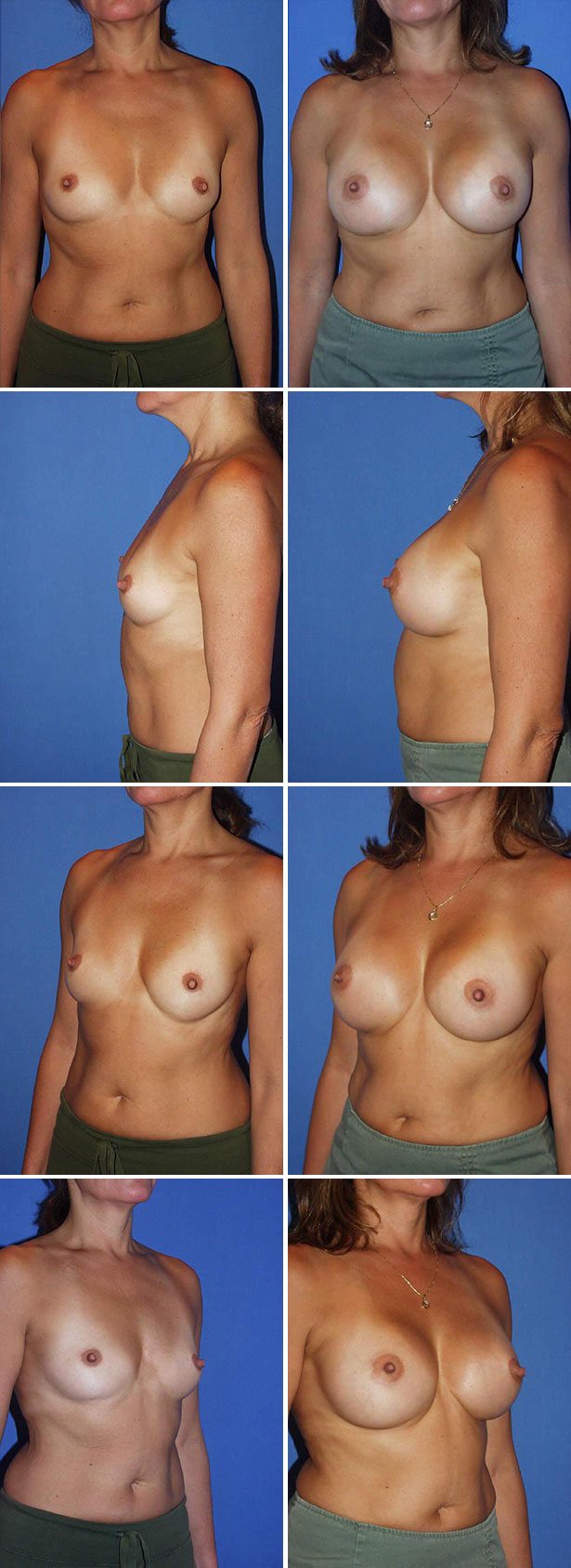 Before and After Image: Breast Augmentation - other