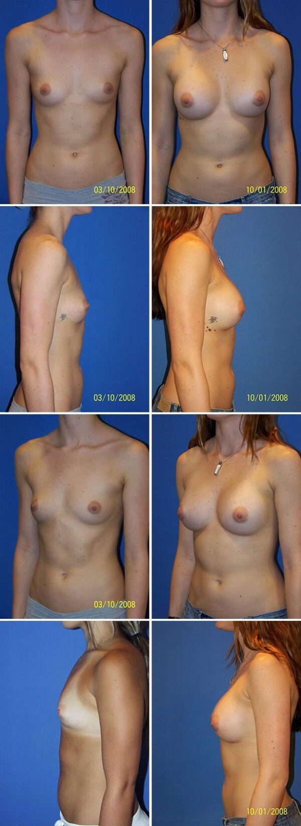 Before and After Image: Breast Augmentation - other