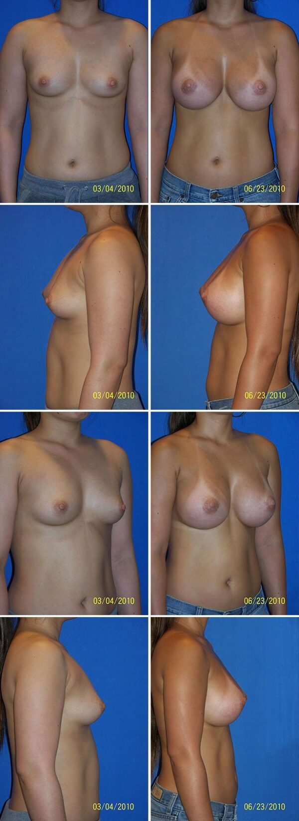 Before and After Image: Breast Augmentation - other