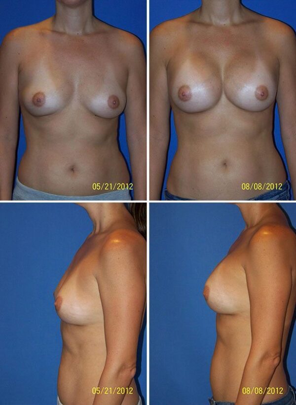 Before and After Image: Breast Augmentation - other