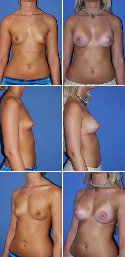Before and After Image: Breast Augmentation - other