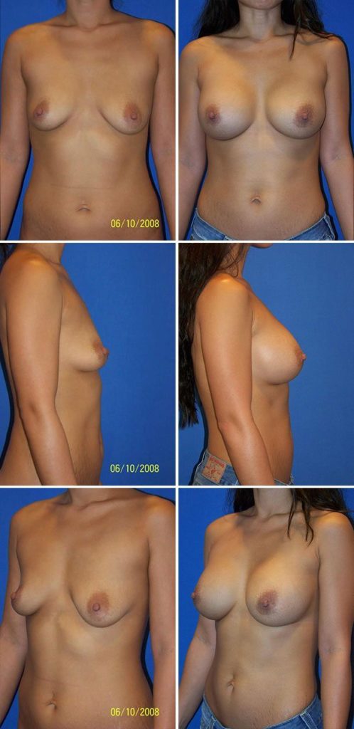 Before and After Image: Breast Augmentation - other