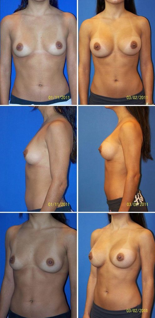 Before and After Image: Breast Augmentation - other