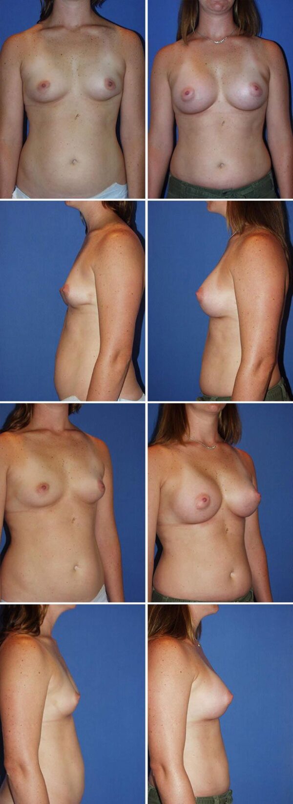Before and After Image: Breast Augmentation - other