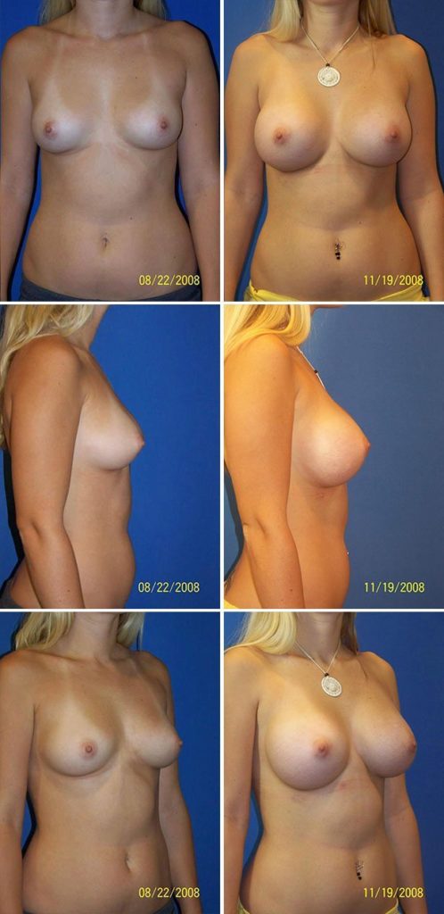 Before and After Image: Breast Augmentation - other