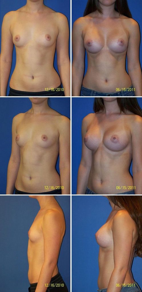 Before and After Image: Breast Augmentation - other