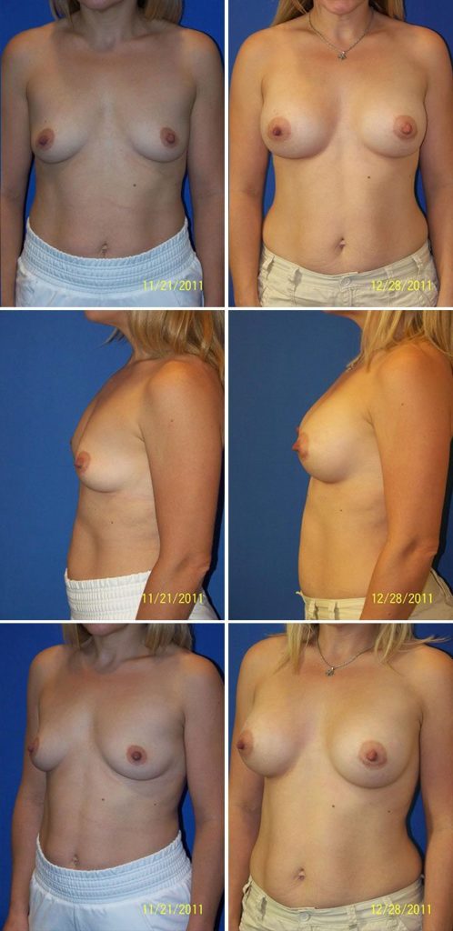 Before and After Image: Breast Augmentation - other