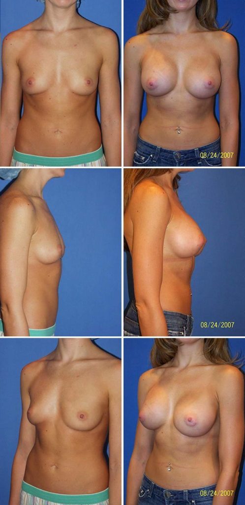 Before and After Image: Breast Augmentation - other