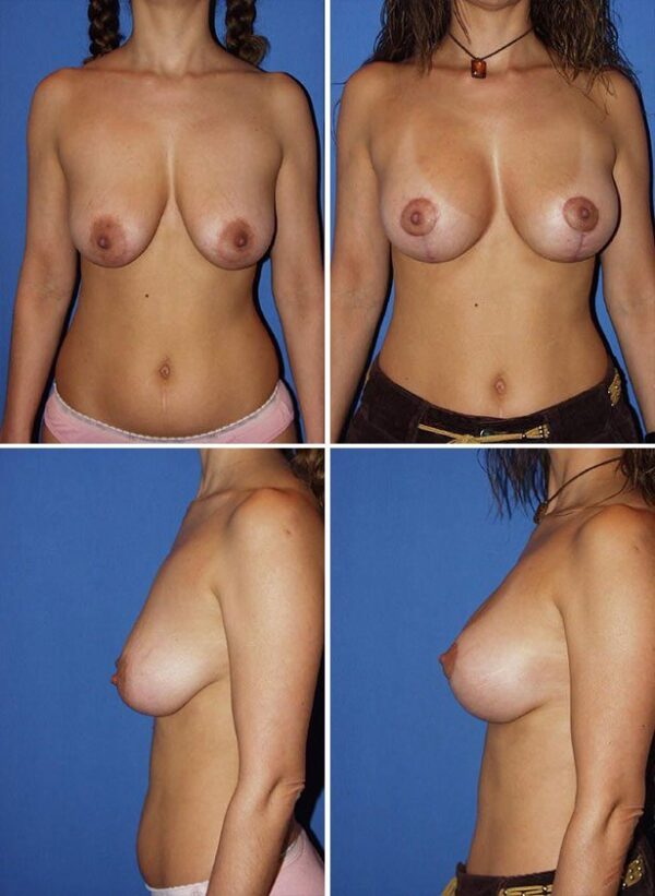Before and After Image: Breast Augmentation with Lift - other