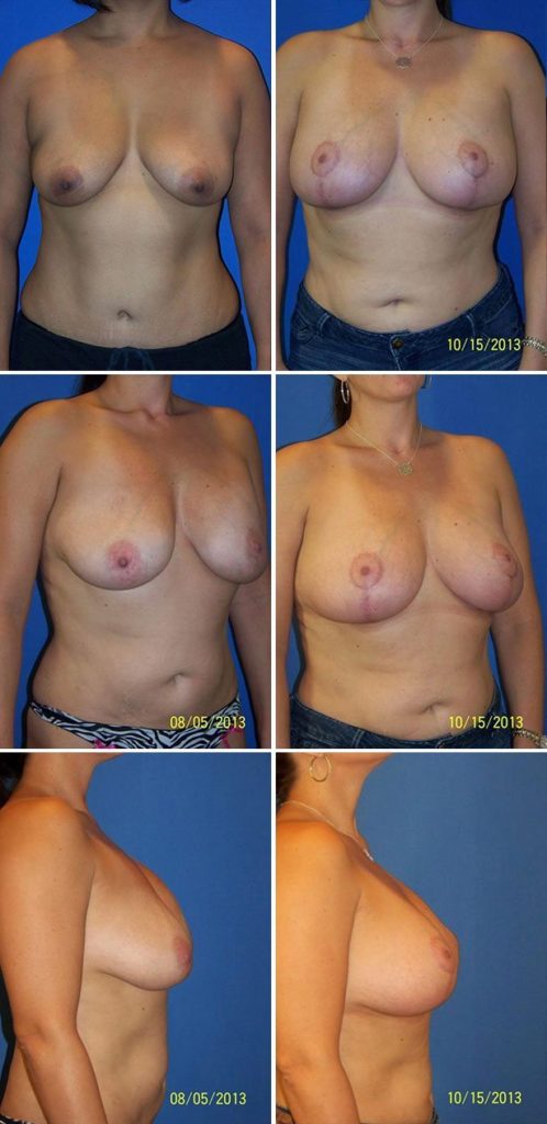 Before and After Image: Breast Augmentation with Lift - other