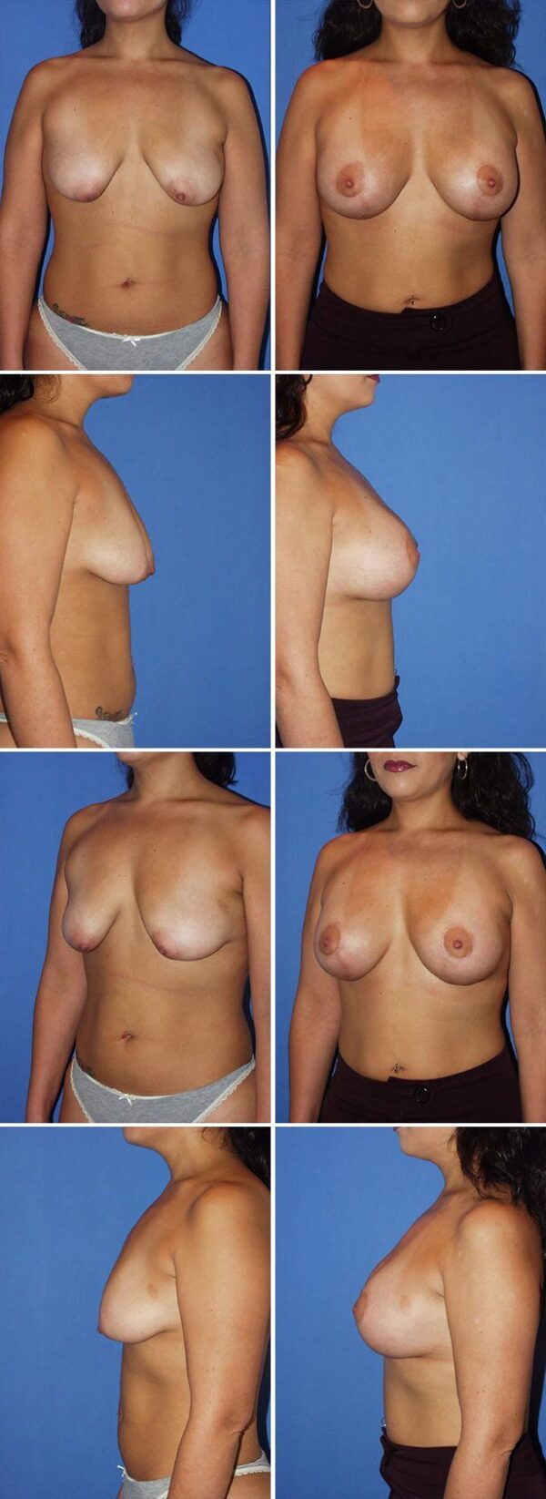 Before and After Image: Breast Augmentation with Lift - other